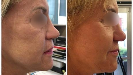 vampire facelift before and after side view